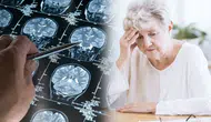 Alzheimer'ın ilk izleri unutkanlıktan yıllar önce ortaya çıkıyor