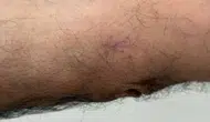Geçmeyen Yaralar Ciddi Hastalığın Habercisi Olabilir