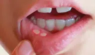 Stres ve vitamin eksikliği ağız içi yaraları tetikliyor