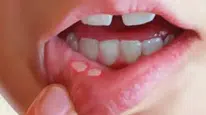 Stres ve vitamin eksikliği ağız içi yaraları tetikliyor