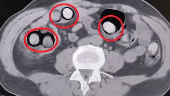 Akılalmaz Kaçakçılık: Mideye Gizlenen 758 Gram Metamfetamin Yakalandı