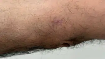Geçmeyen Yaralar Ciddi Hastalığın Habercisi Olabilir