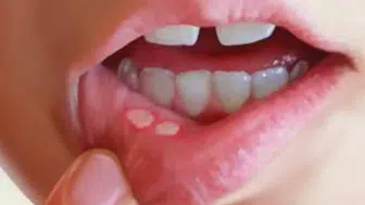 Stres ve vitamin eksikliği ağız içi yaraları tetikliyor