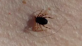 Sivas’ta kene nedeniyle 6. ölüm