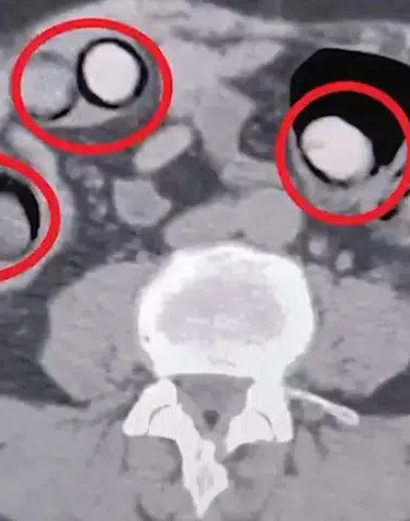 Akılalmaz Kaçakçılık: Mideye Gizlenen 758 Gram Metamfetamin Yakalandı