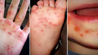 Yaz Aylarında El, Ayak ve Ağız Hastalığına Dikkat: Havuzlar Risk Oluşturuyor