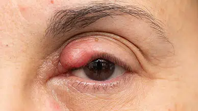 Gözde Yanma ve Batmayı Hafife Almayın: Uzmandan Kritik Uyarı