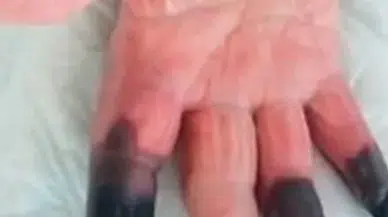 Kangren bir kader mi, önlenebilir mi? Kangren artık kazalardan değil, masabaşından geliyor
