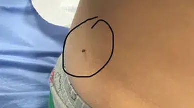 Sivas’ta Kene Alarmı: Kırsalda Risk Artıyor