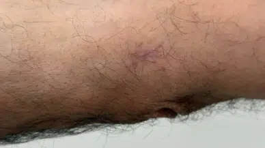 Geçmeyen Yaralar Ciddi Hastalığın Habercisi Olabilir