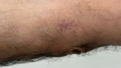Geçmeyen Yaralar Ciddi Hastalığın Habercisi Olabilir