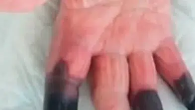 Kangren bir kader mi, önlenebilir mi? Kangren artık kazalardan değil, masabaşından geliyor