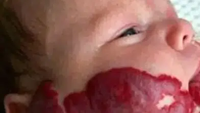 Doğum lekeleri ciddi nörolojik hastalıkların habercisi olabilir