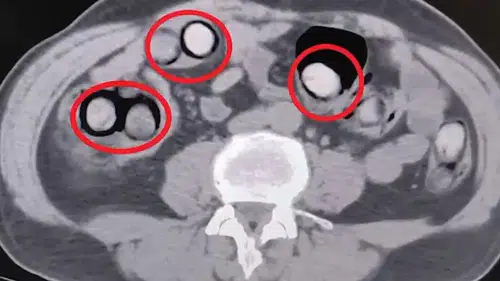 Akılalmaz Kaçakçılık: Mideye Gizlenen 758 Gram Metamfetamin Yakalandı