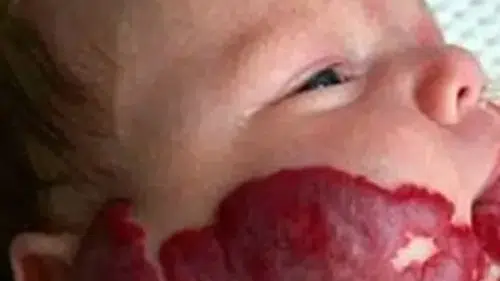 Doğum lekeleri ciddi nörolojik hastalıkların habercisi olabilir
