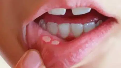 Stres ve vitamin eksikliği ağız içi yaraları tetikliyor