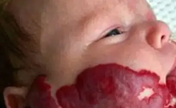 Doğum lekeleri ciddi nörolojik hastalıkların habercisi olabilir