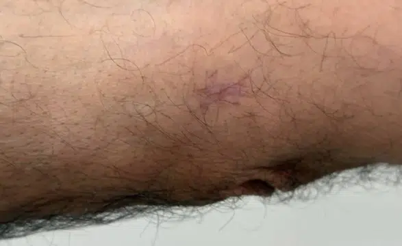 Geçmeyen Yaralar Ciddi Hastalığın Habercisi Olabilir