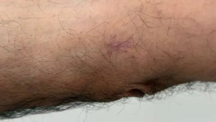 Geçmeyen Yaralar Ciddi Hastalığın Habercisi Olabilir