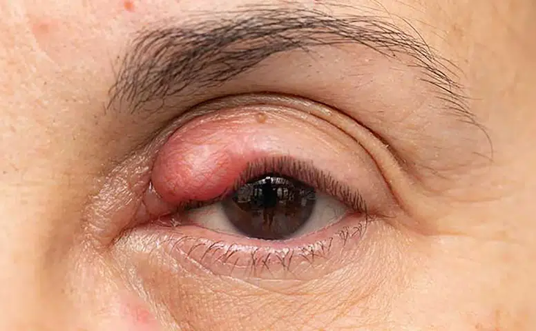 Gözde Yanma ve Batmayı Hafife Almayın: Uzmandan Kritik Uyarı
