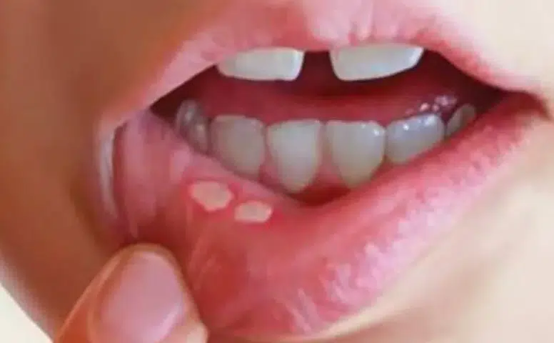 Stres ve vitamin eksikliği ağız içi yaraları tetikliyor
